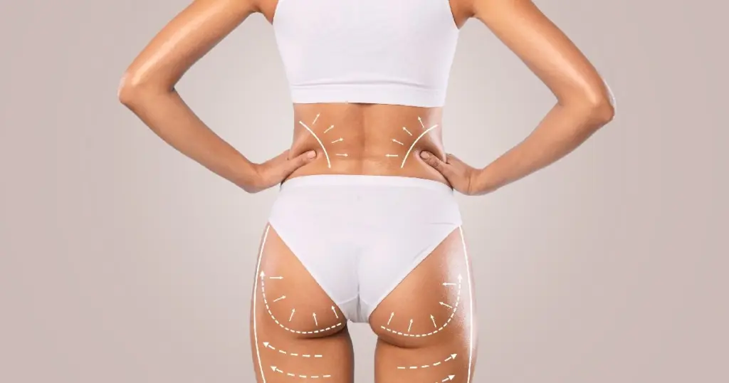 Sculptra BBL treatment in New Jersey