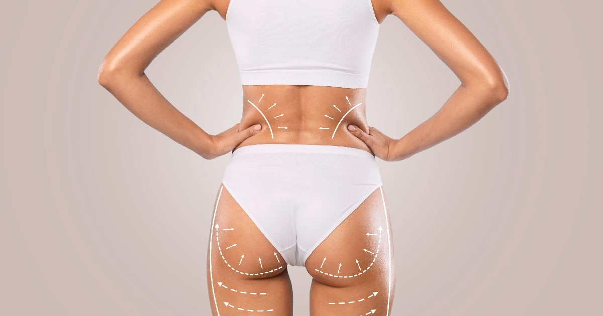 Sculptra BBL treatment in New Jersey